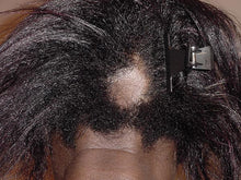 Load image into Gallery viewer, BEFORE: Embark on a journey of hair transformation with our Herbal Re-Growth Serum, carefully crafted to harness the revitalizing power of nature. Enriched with a fusion of botanical extracts, including invigorating Moringa, Nettle, Amla, Ginseng, Gingko Biloba, Lavender Essential Oil, and Revitalizing Ginseng. Our serum is a testament to the potency of herbal remedies for hair care.